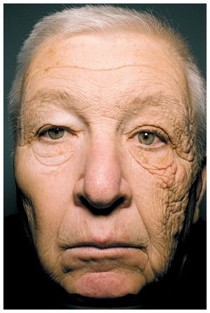 69 year old truck driver with 30 years of UVA exposure to left face only