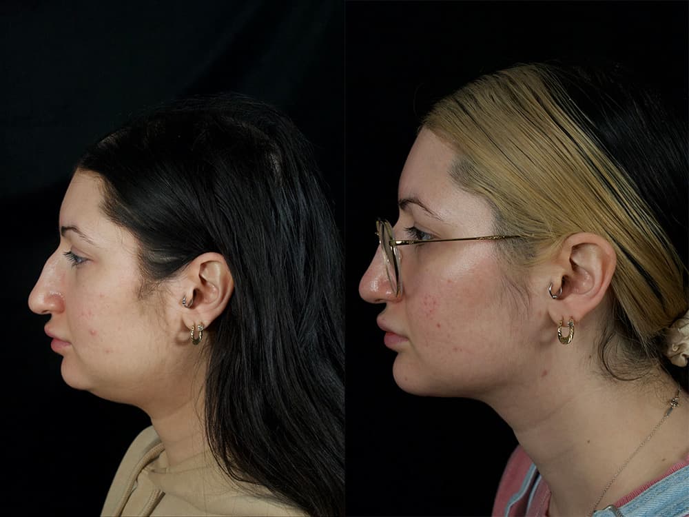 Chin Implant Before & After Image