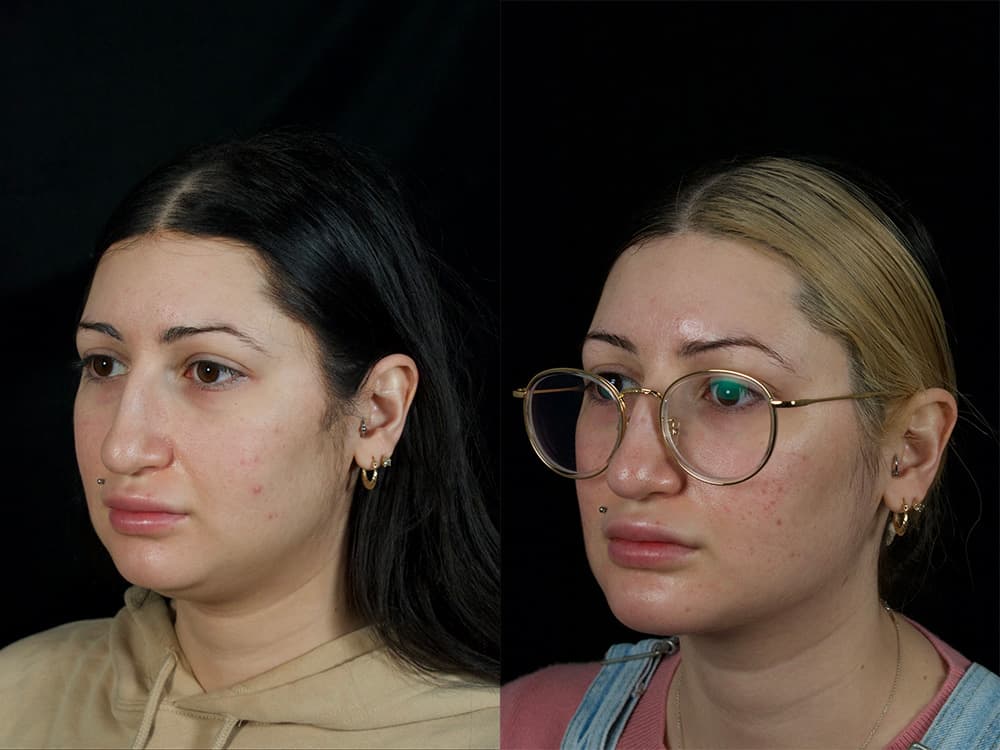 Chin Implant Before & After Image