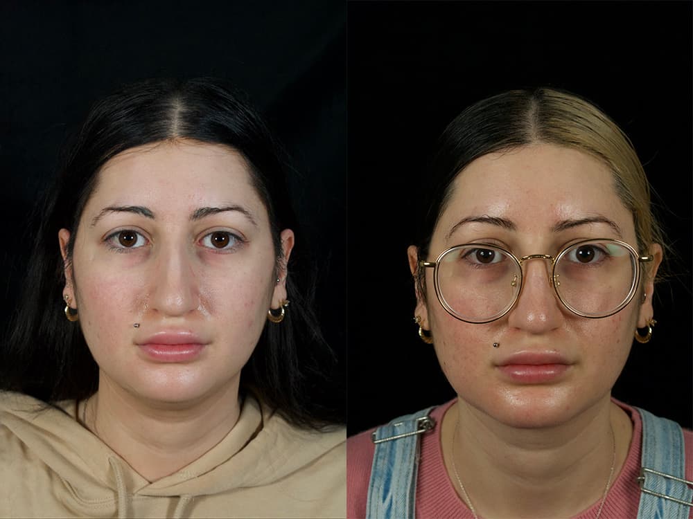 Chin Implant Before & After Image