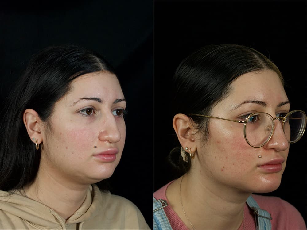 Chin Implant Before & After Image