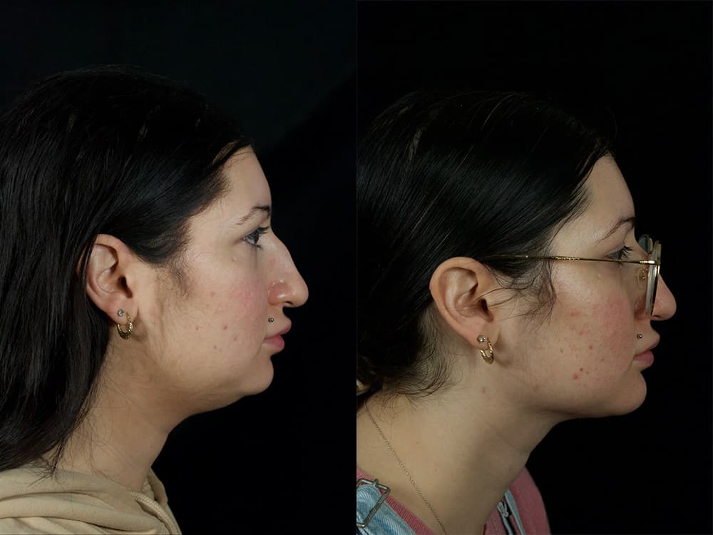 Chin Implant Before & After Image