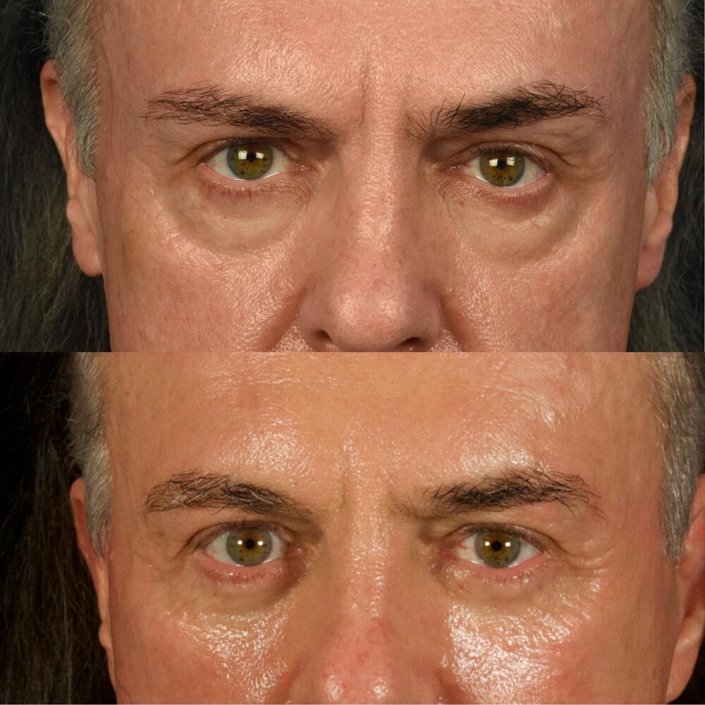 Lower-Eyelid Surgery Before & After Image