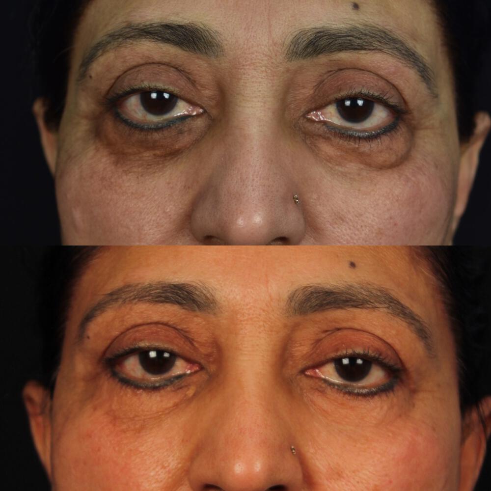 Lower-Eyelid Surgery Before & After Image