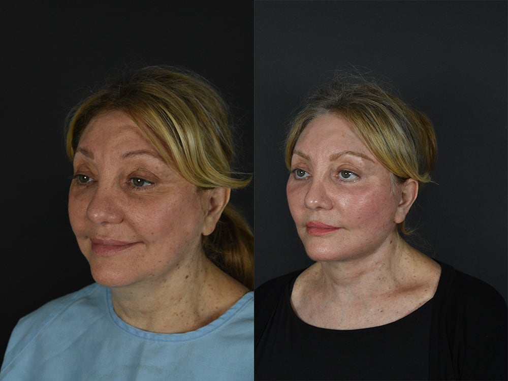 Lower-Eyelid Surgery Before & After Image