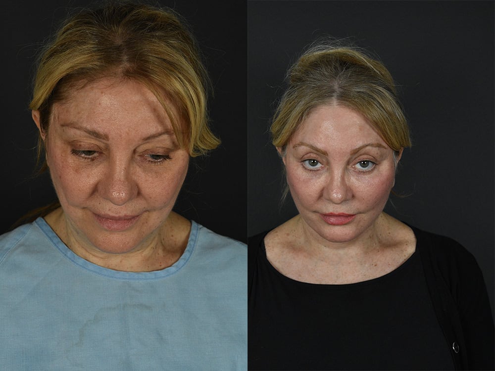 Lower-Eyelid Surgery Before & After Image