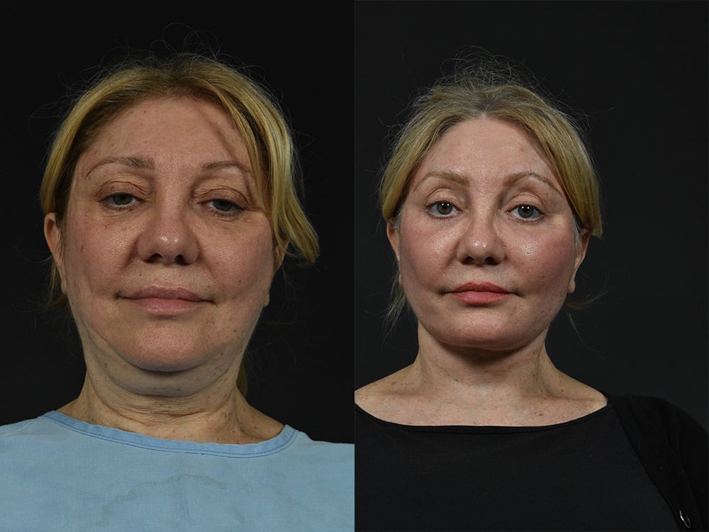 Lower-Eyelid Surgery Before & After Image