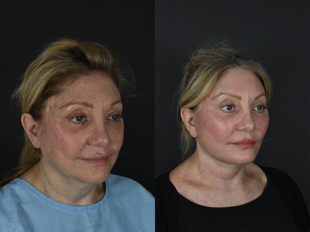 Lower-Eyelid Surgery Before & After Image