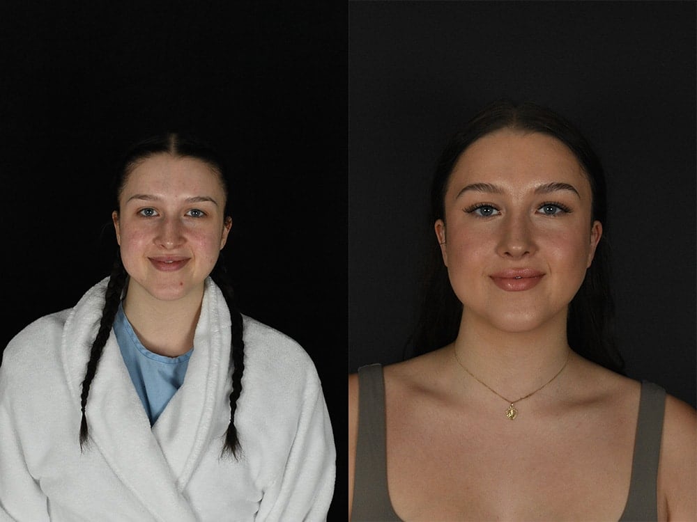 Septorhinoplasty Before & After Image