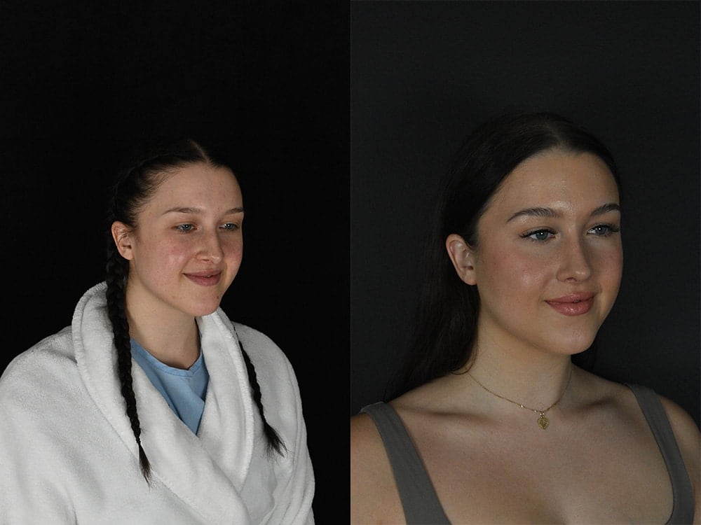 Septorhinoplasty Before & After Image