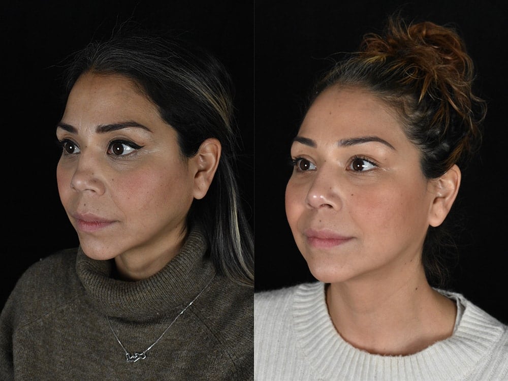 Septorhinoplasty Before & After Image