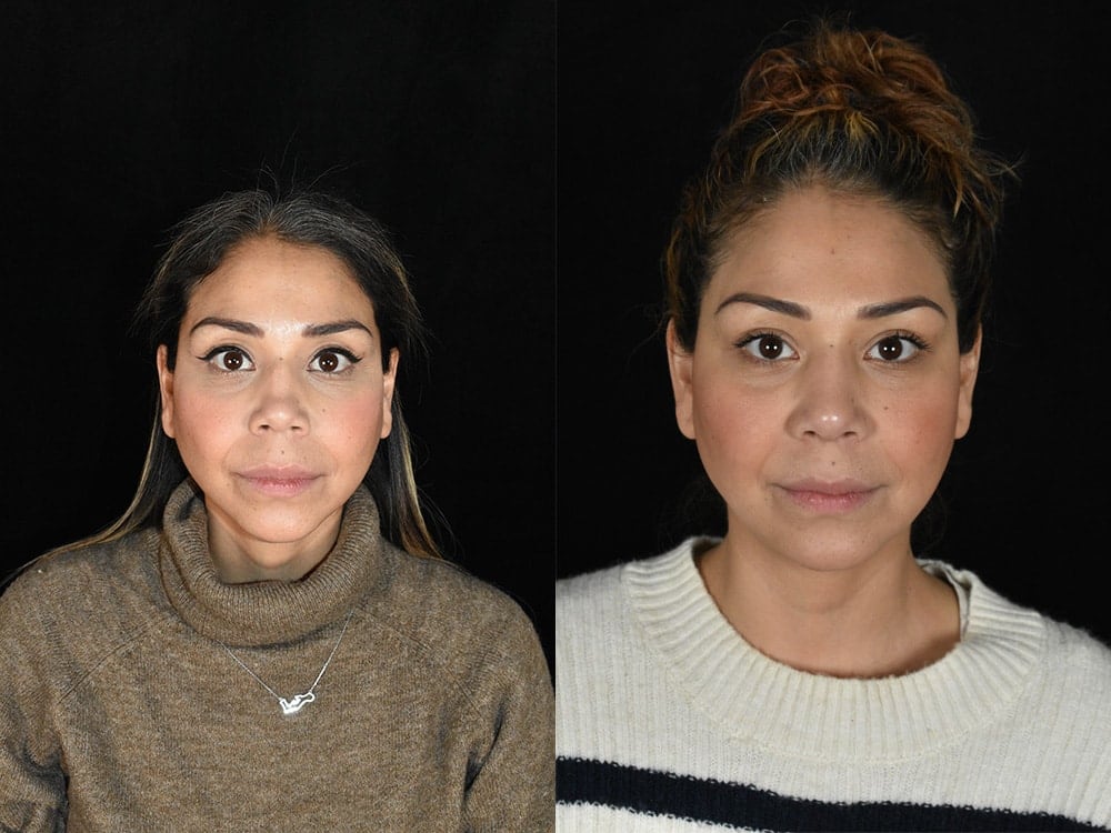 Septorhinoplasty Before & After Image