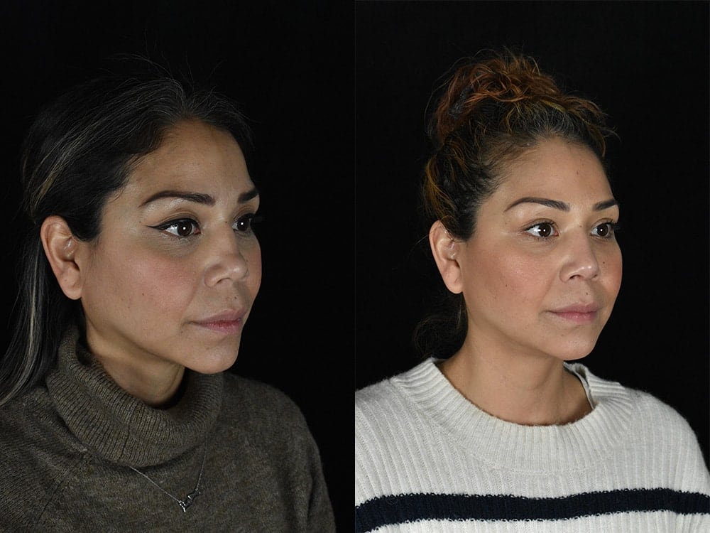 Septorhinoplasty Before & After Image