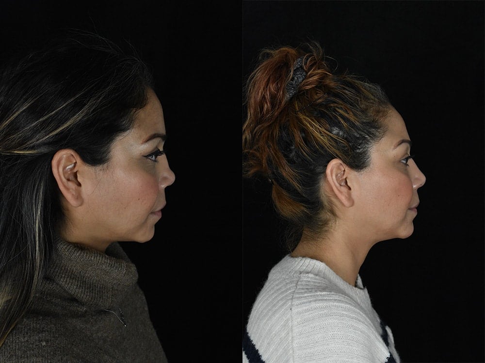 Septorhinoplasty Before & After Image