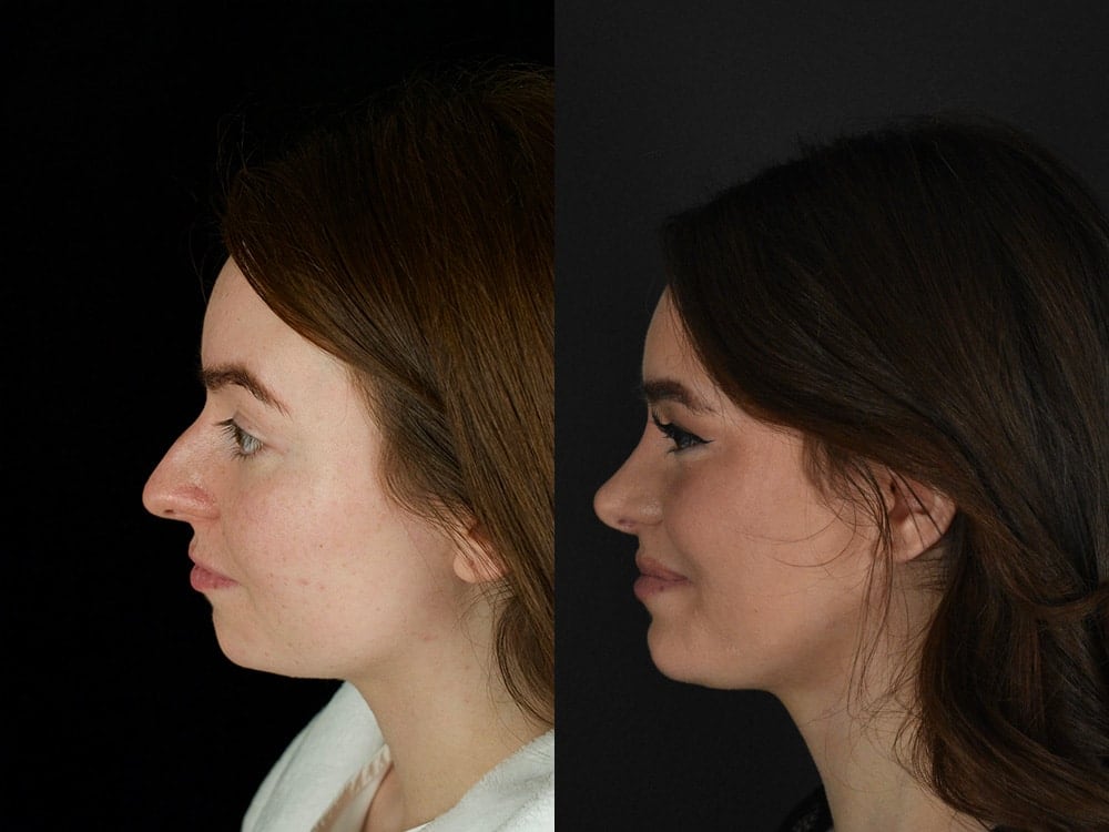 Septorhinoplasty Before & After Image