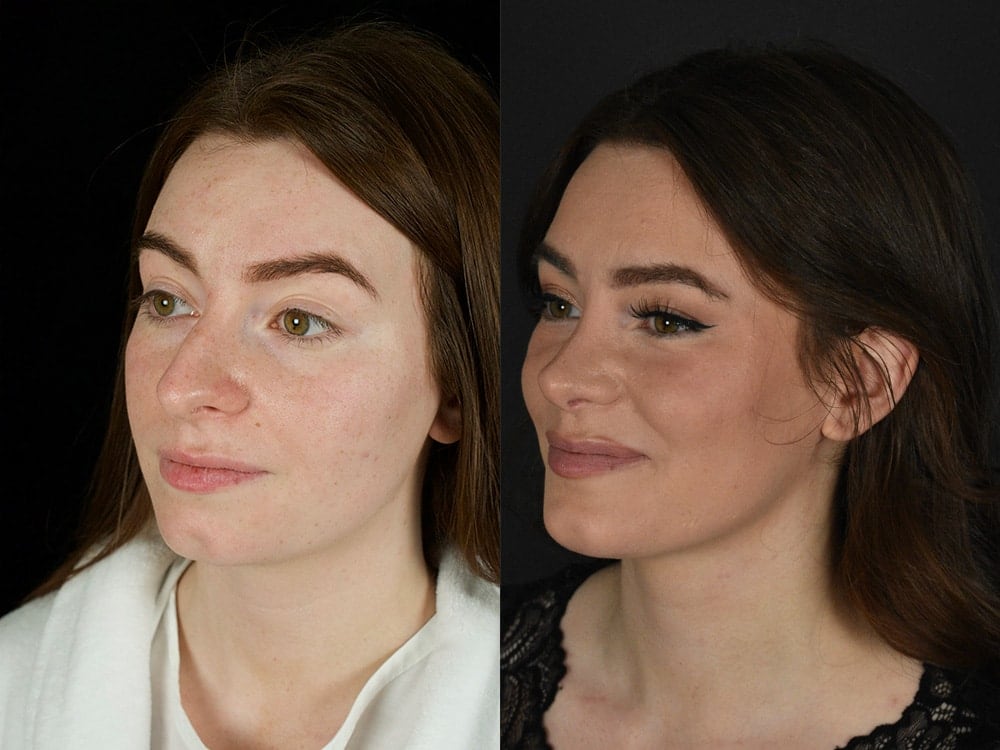 Septorhinoplasty Before & After Image