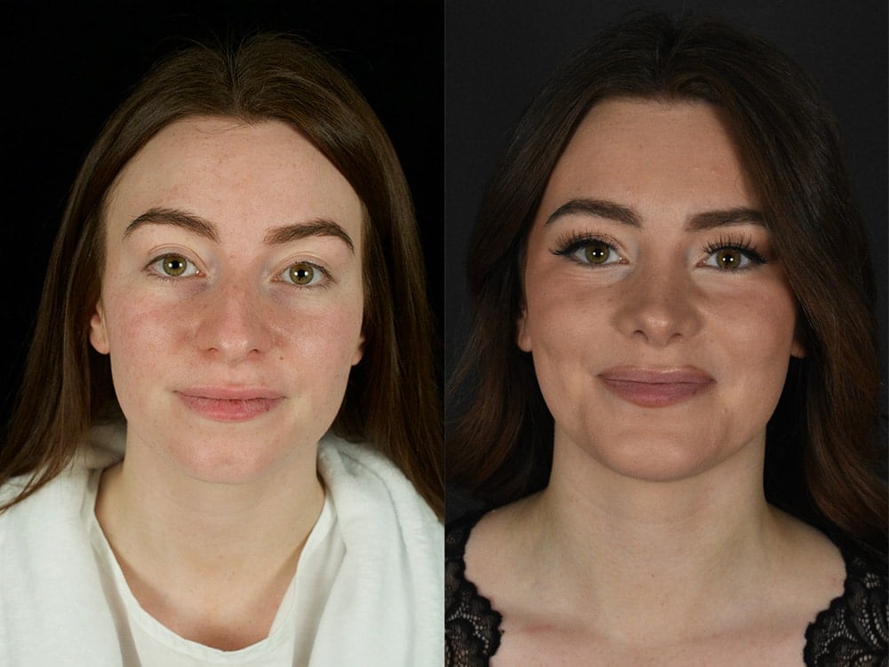 Septorhinoplasty Before & After Image