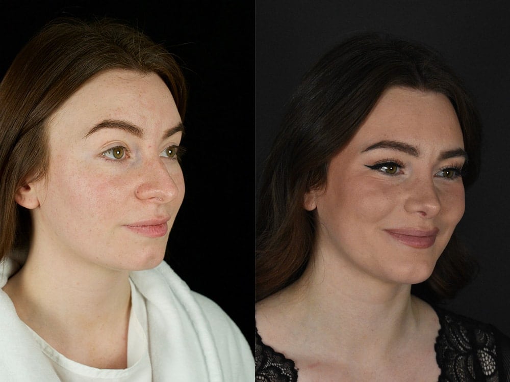 Septorhinoplasty Before & After Image