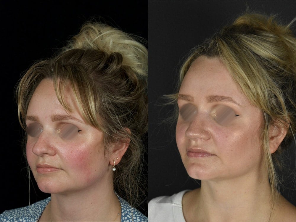 Septorhinoplasty Before & After Image