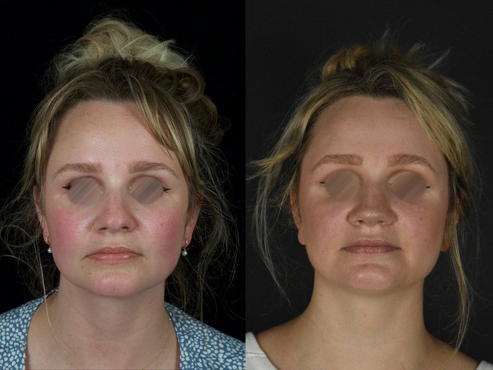 Septorhinoplasty Before & After Image