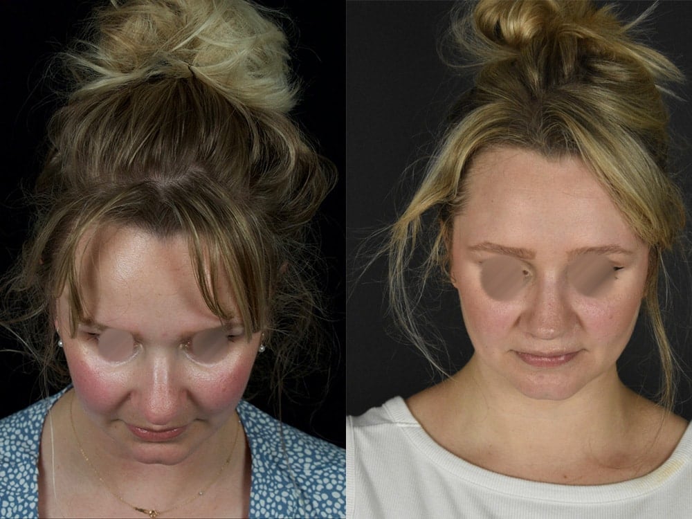 Septorhinoplasty Before & After Image