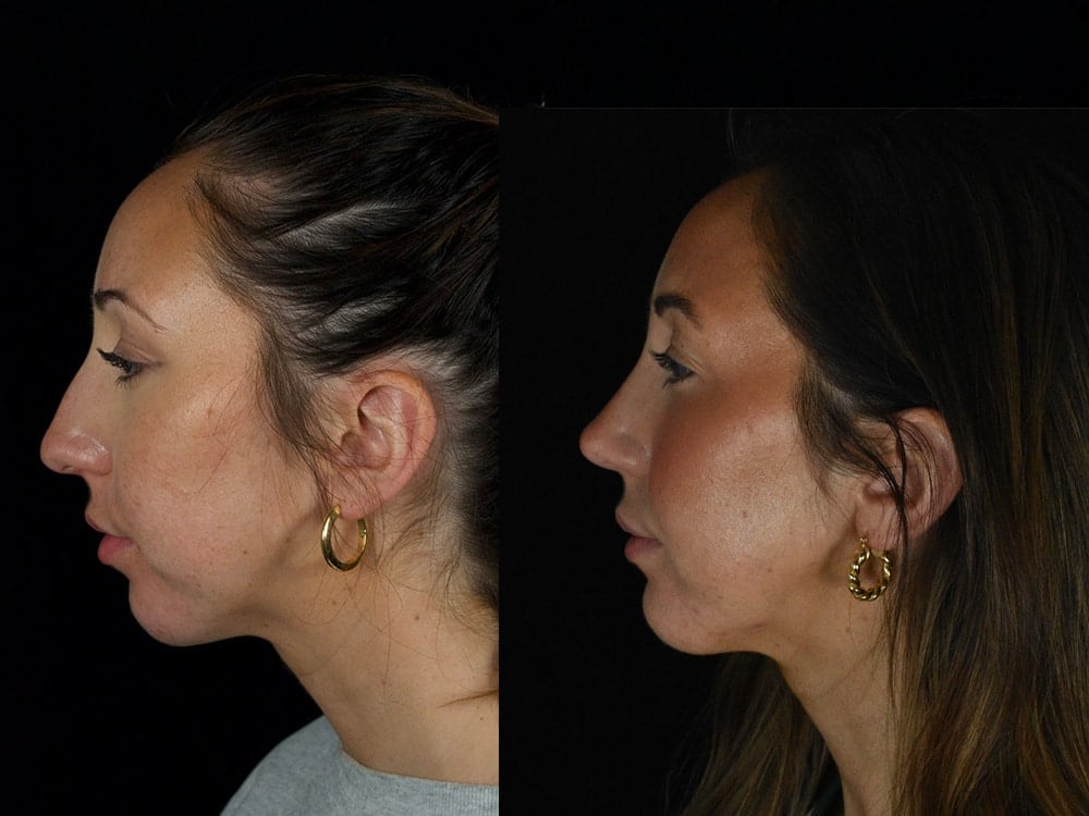 Septorhinoplasty Before & After Image