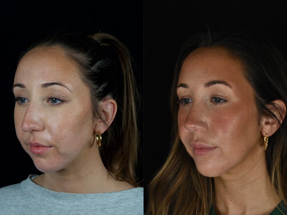 Septorhinoplasty Before & After Image