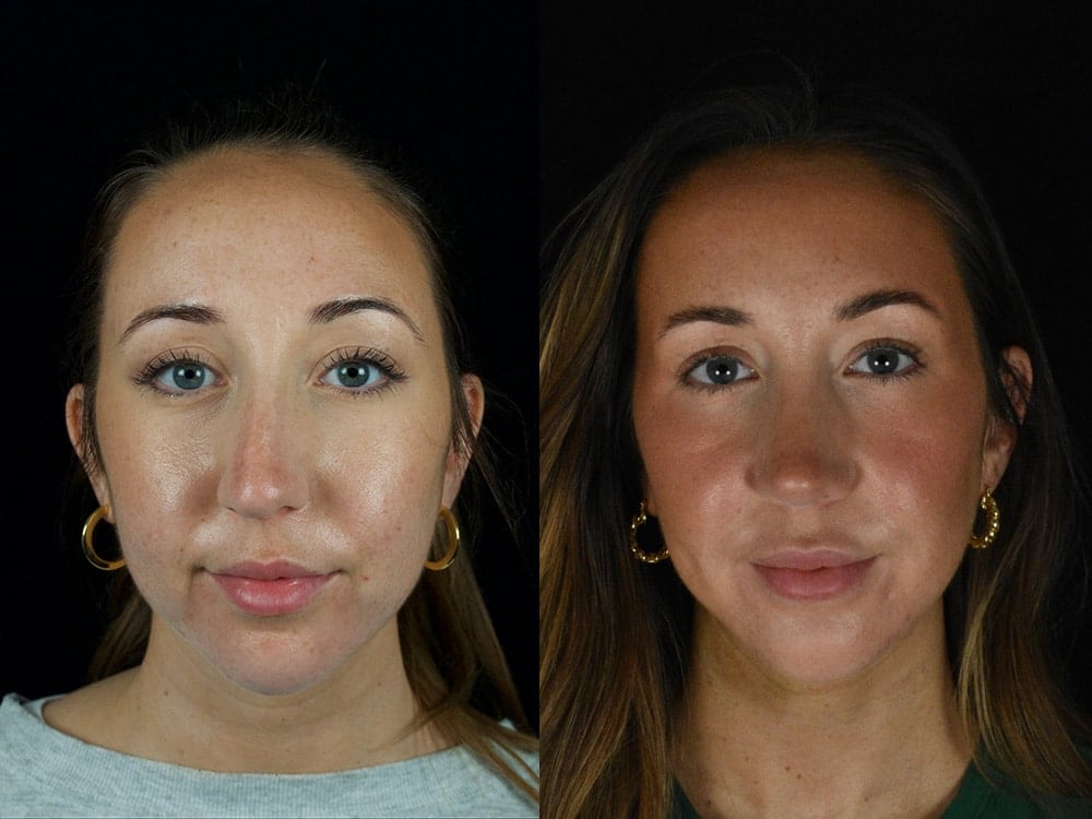 Septorhinoplasty Before & After Image