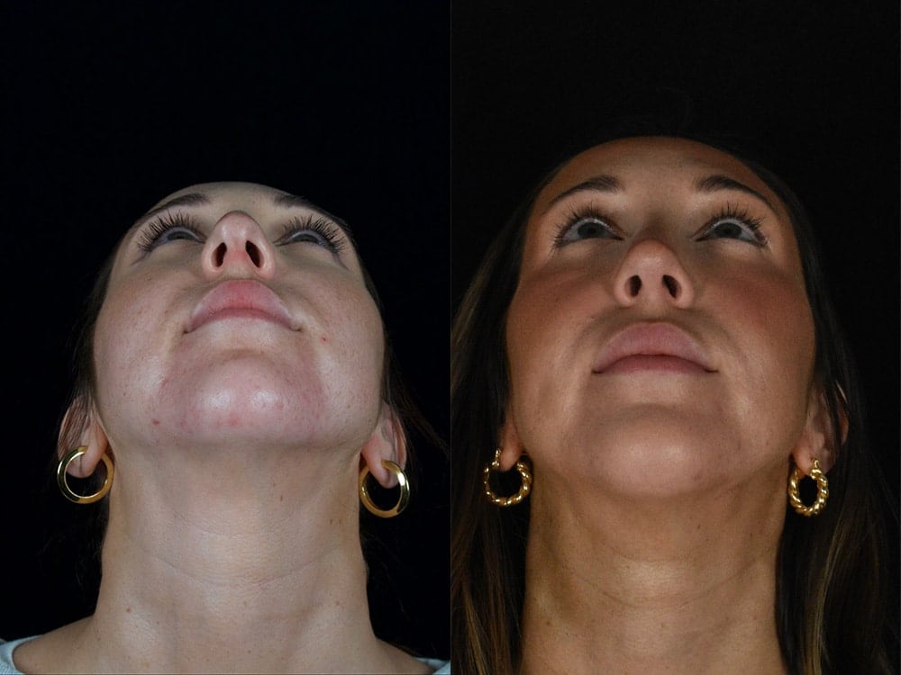 Septorhinoplasty Before & After Image