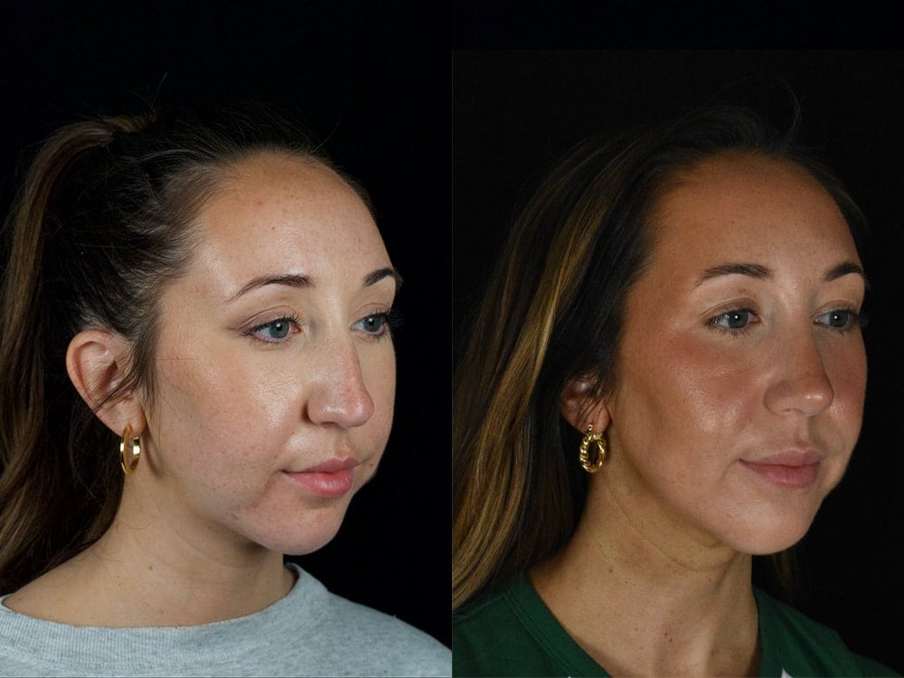 Septorhinoplasty Before & After Image