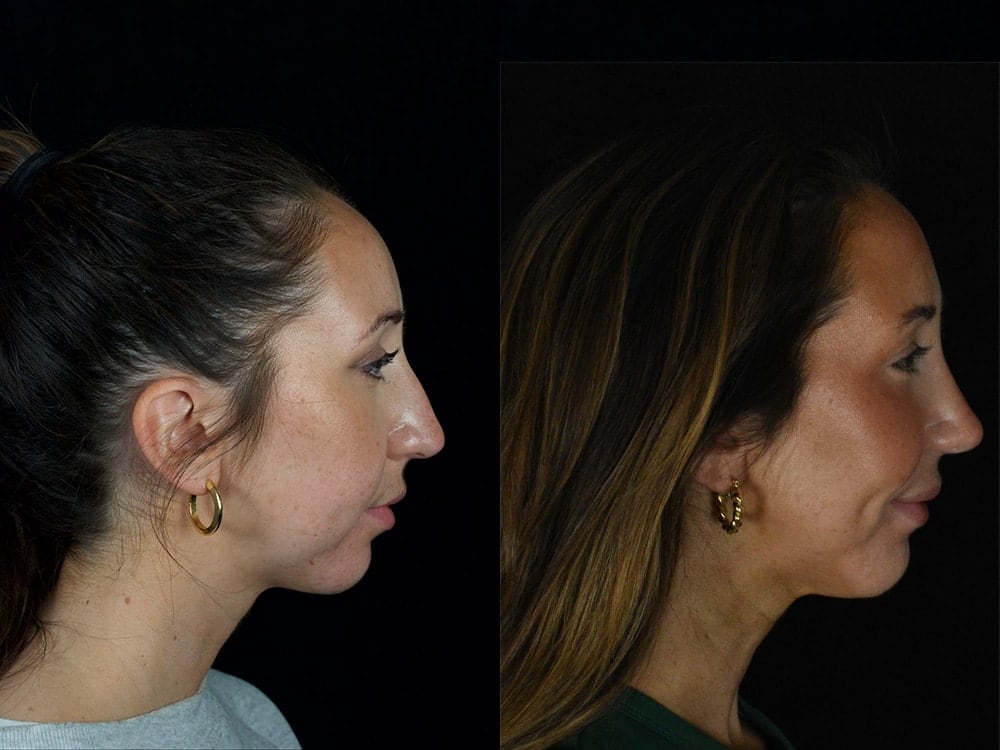 Septorhinoplasty Before & After Image