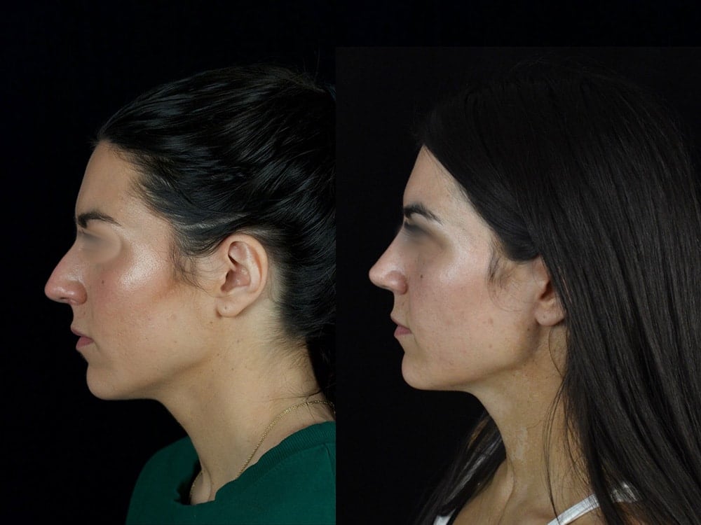 Septorhinoplasty Before & After Image