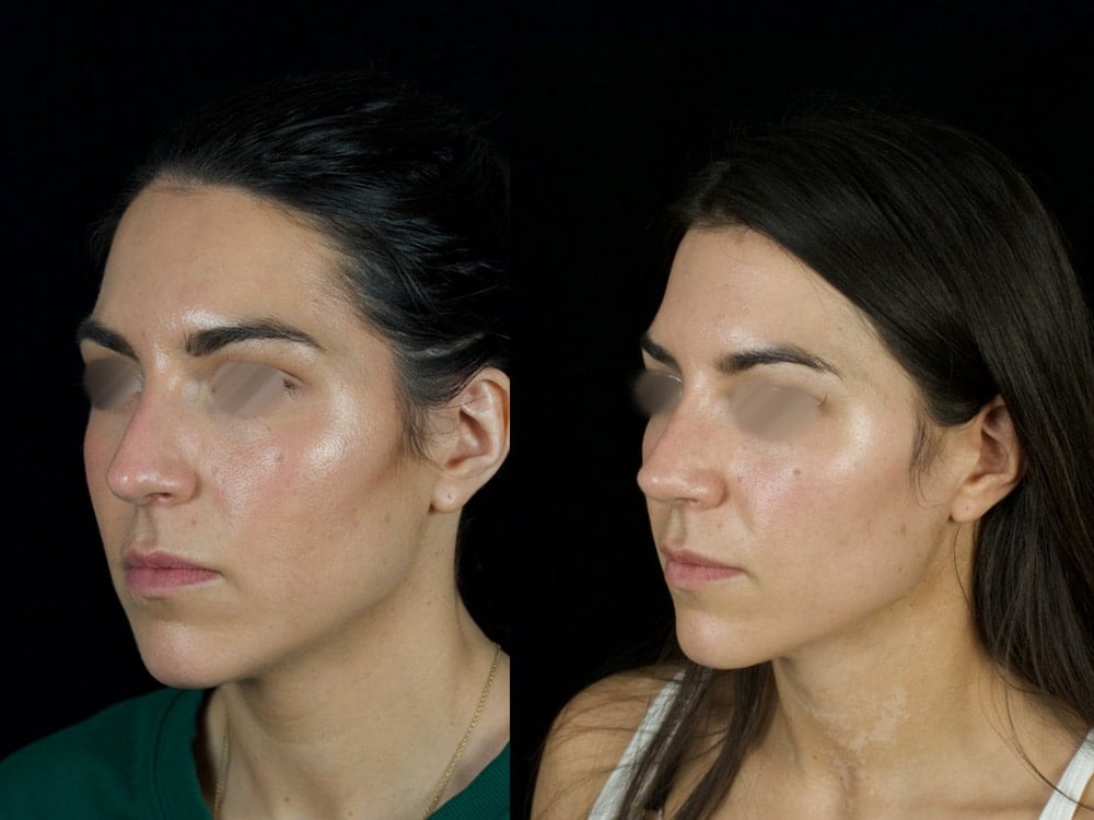 Septorhinoplasty Before & After Image