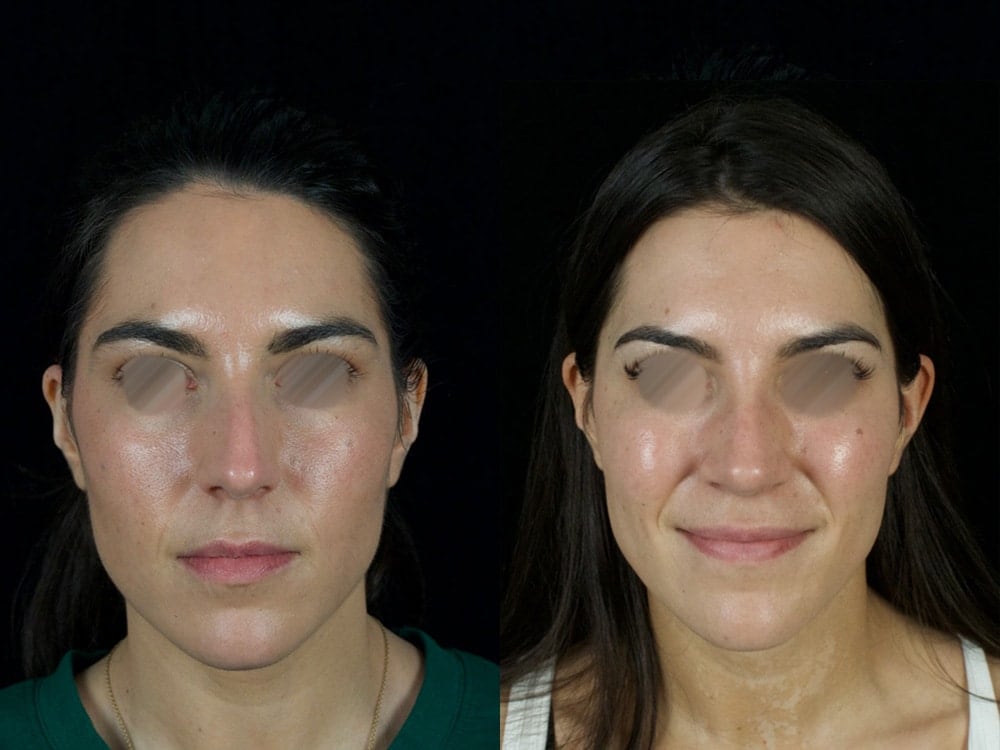 Septorhinoplasty Before & After Image