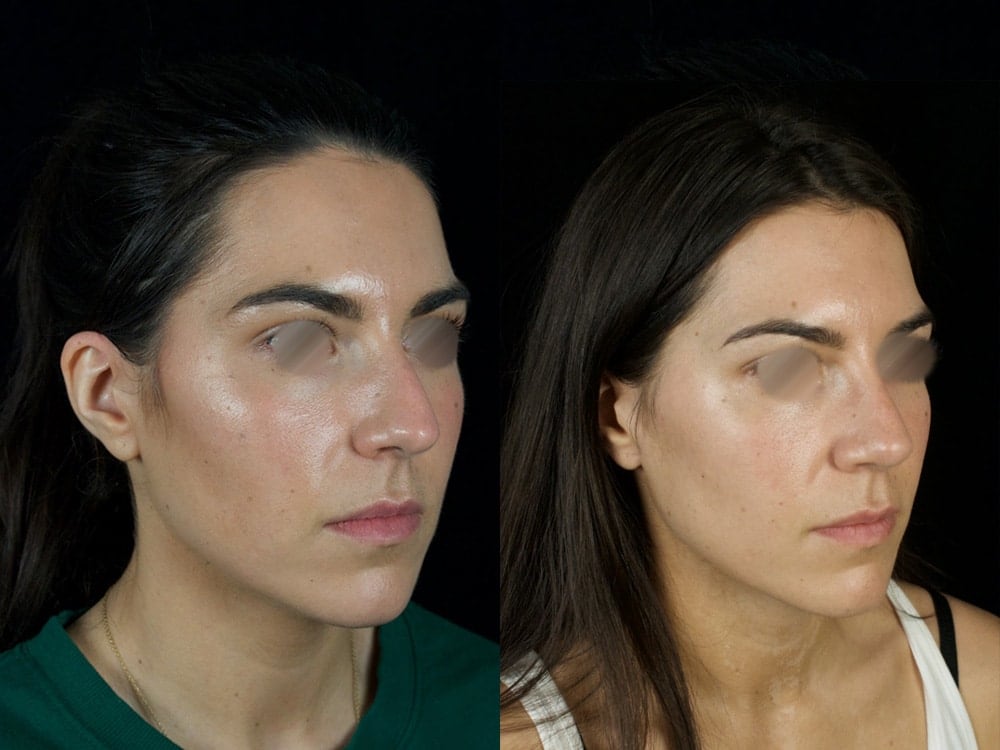 Septorhinoplasty Before & After Image