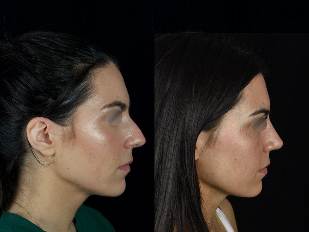 Septorhinoplasty Before & After Image