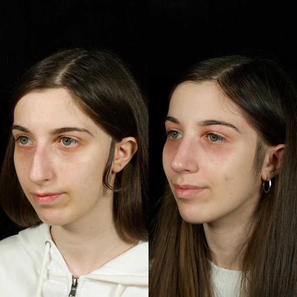 Septorhinoplasty Before & After Image