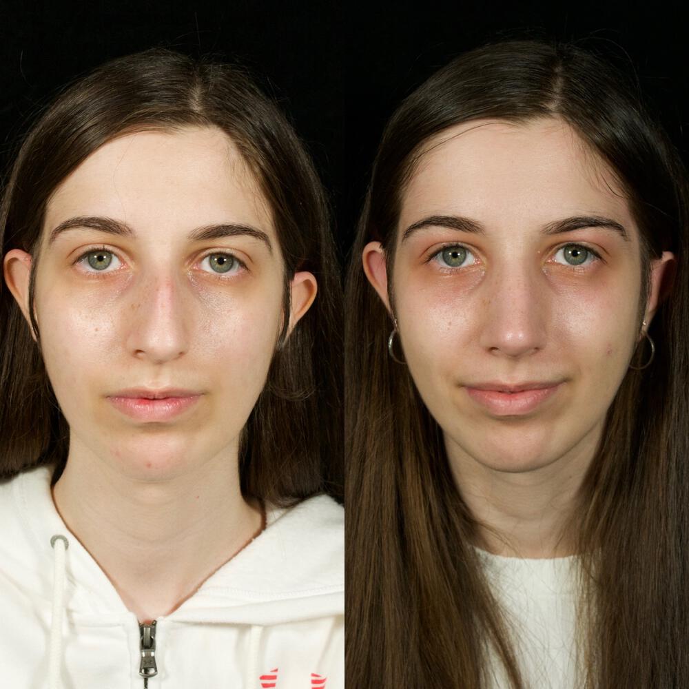 Septorhinoplasty Before & After Image