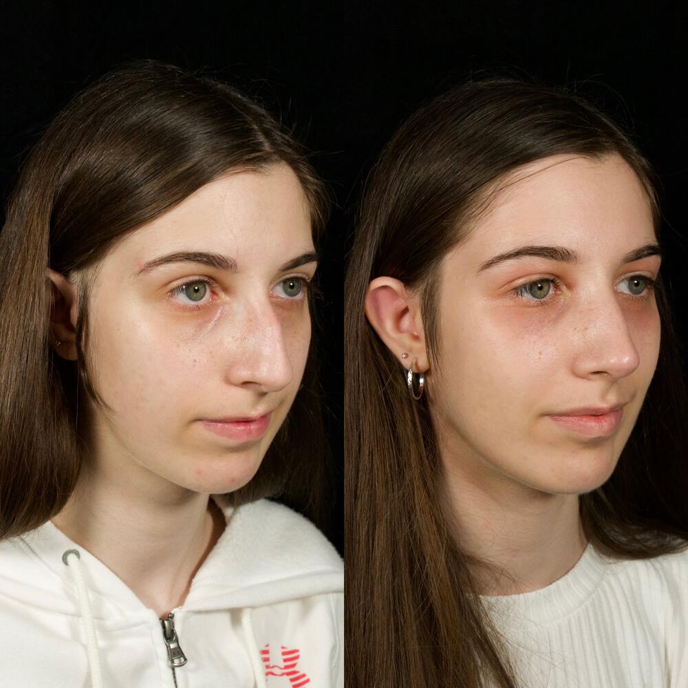 Septorhinoplasty Before & After Image