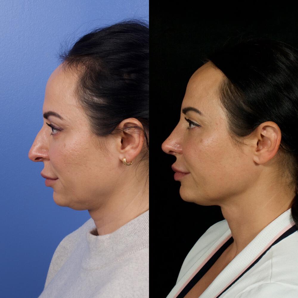 Septorhinoplasty Before & After Image