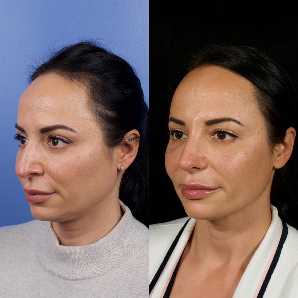 Septorhinoplasty Before & After Image