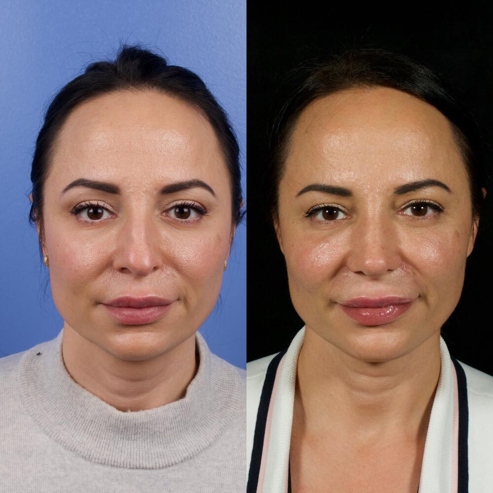 Septorhinoplasty Before & After Image