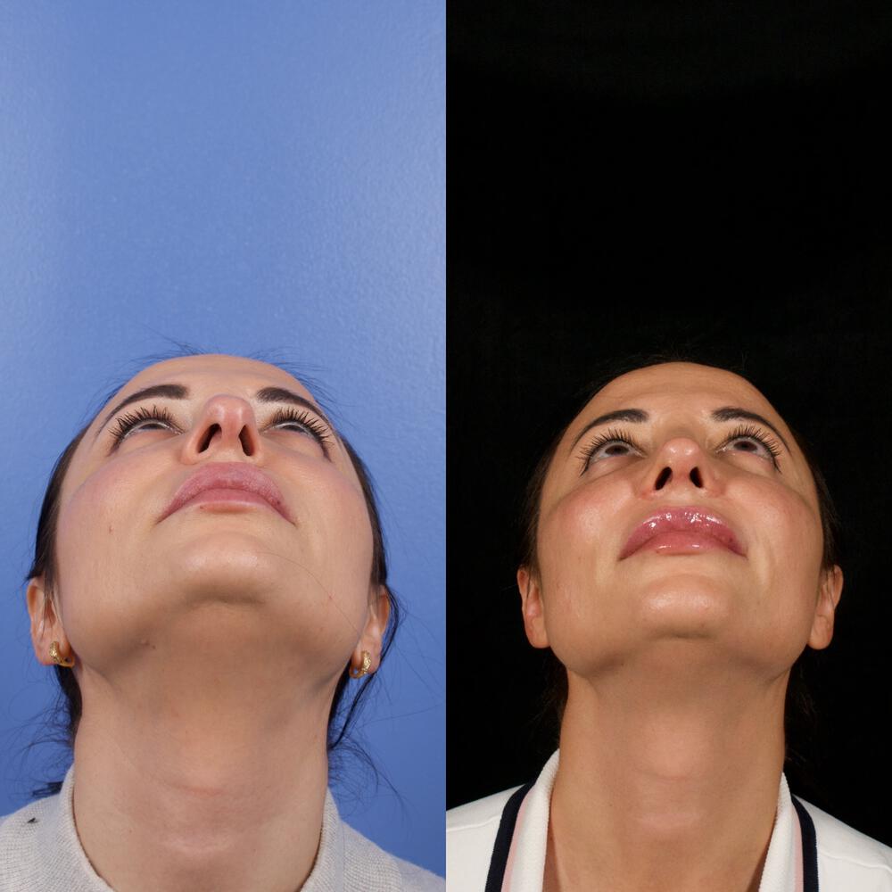 Septorhinoplasty Before & After Image