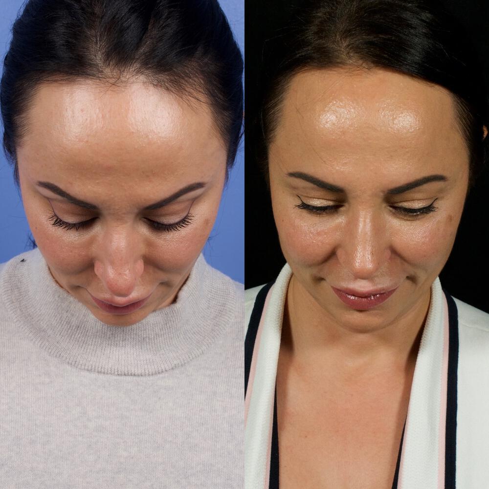 Septorhinoplasty Before & After Image