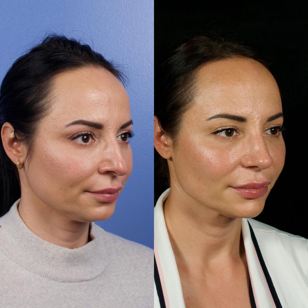 Septorhinoplasty Before & After Image