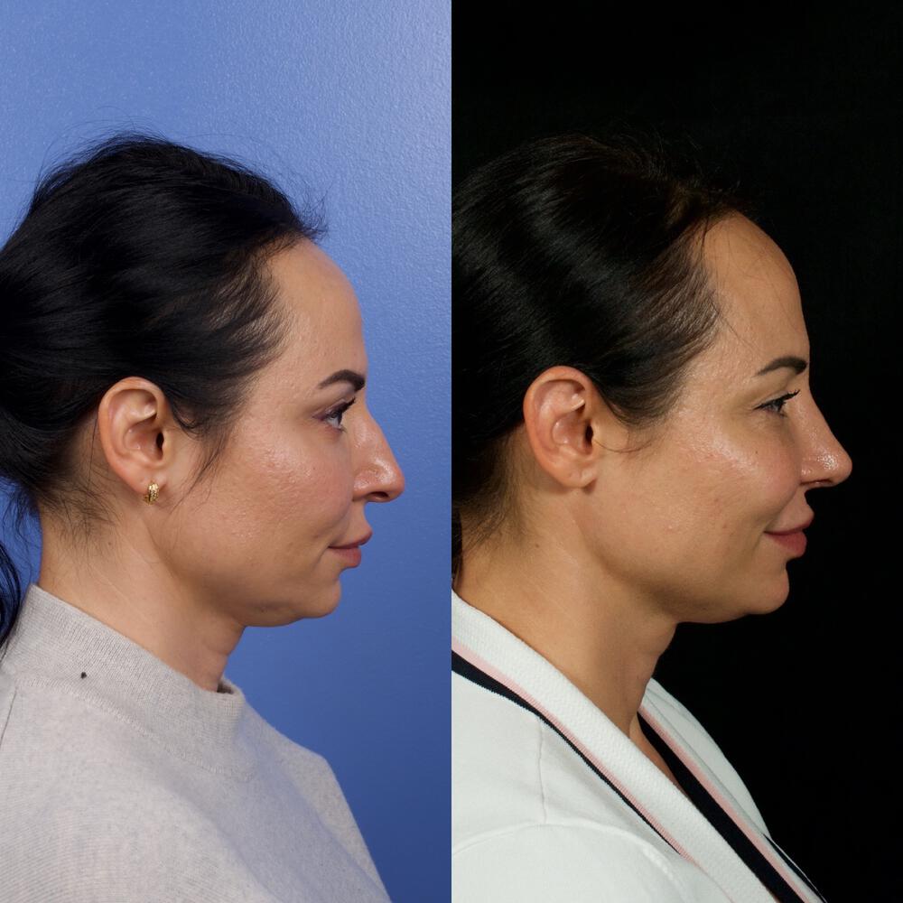 Septorhinoplasty Before & After Image