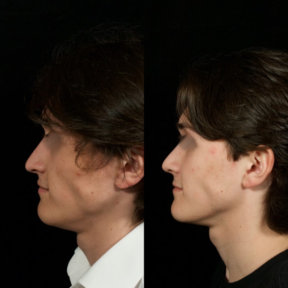 Septorhinoplasty Before & After Image