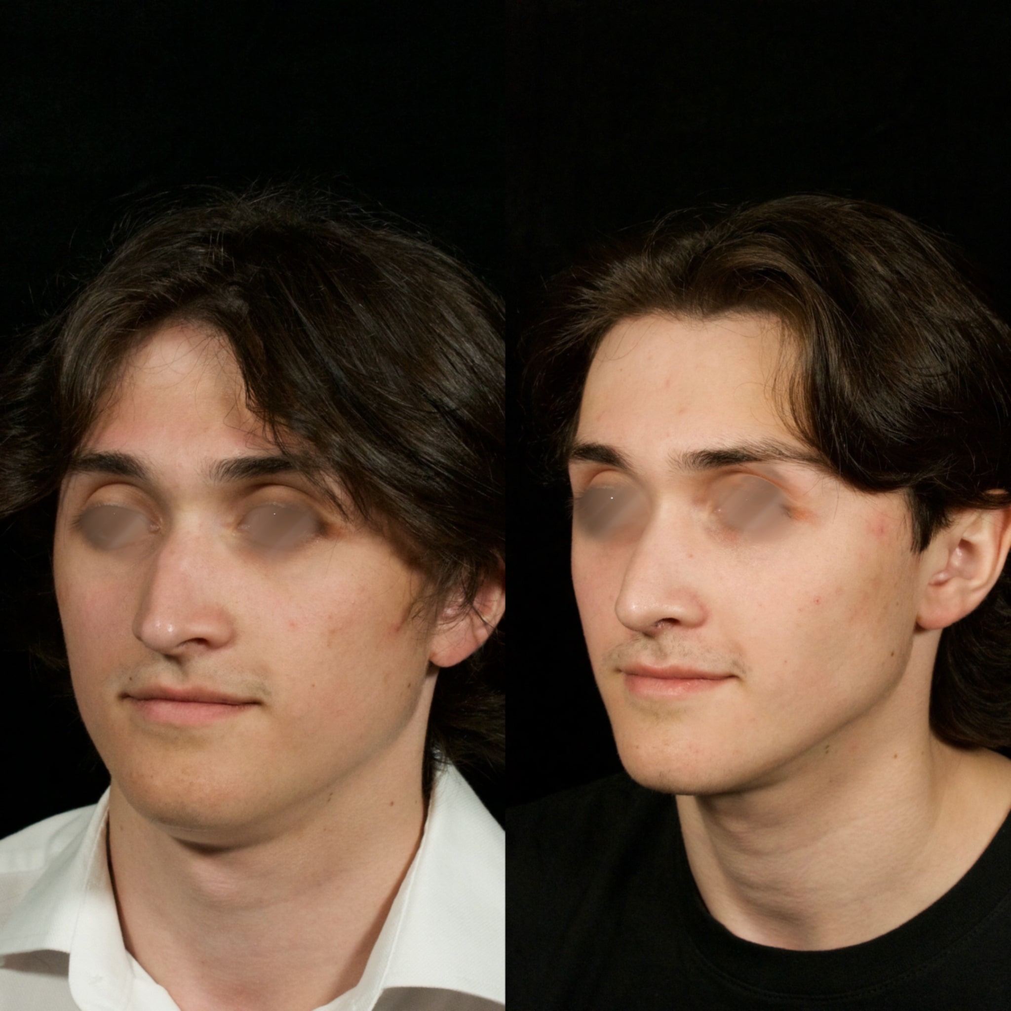 Septorhinoplasty Before & After Image