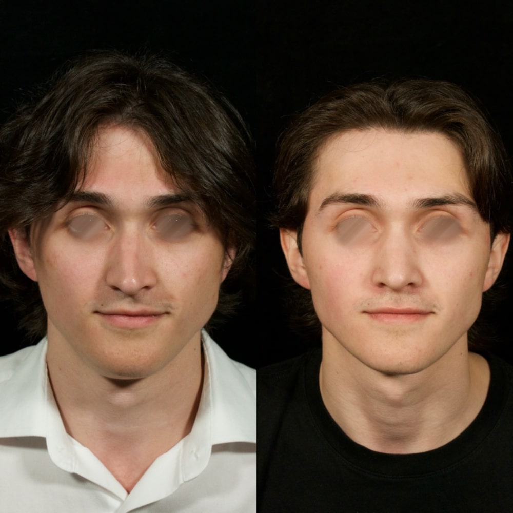 Septorhinoplasty Before & After Image