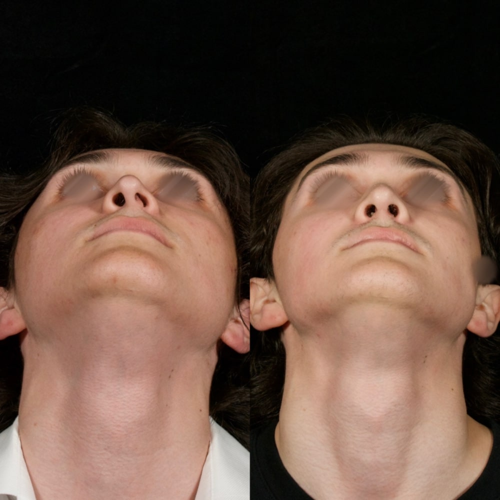 Septorhinoplasty Before & After Image